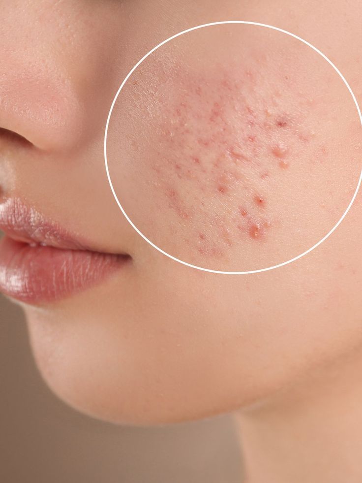 Acne Treatment